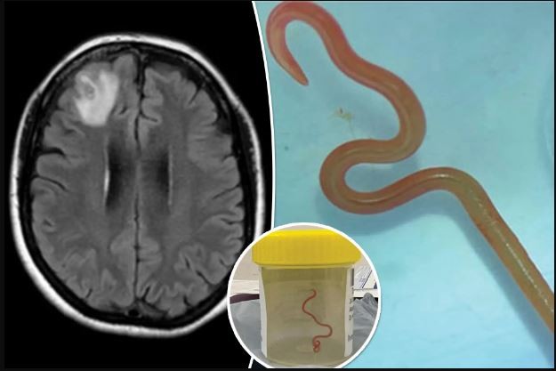 Live worm found in woman’s brain